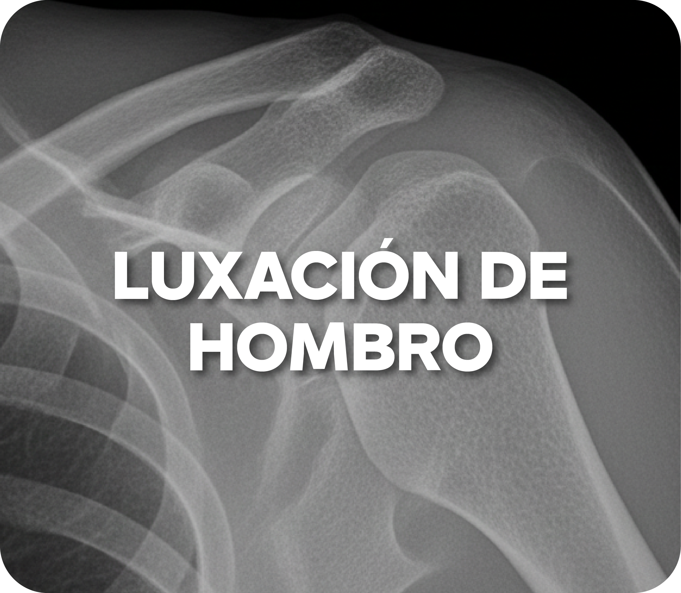 Luxación de hombro